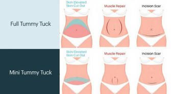 Tummy tuck: A wonderful journey of 'belly renewal'