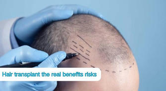 Hair Transplant: The Real Benefits, Risks, and Success Stories You Need to Know